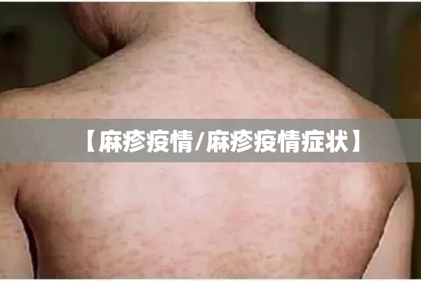 【麻疹疫情/麻疹疫情症状】