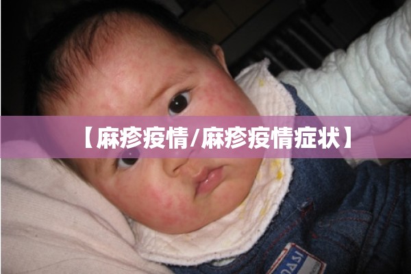 【麻疹疫情/麻疹疫情症状】